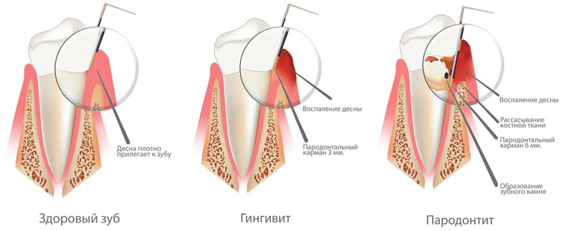 Раннее лечение зубов