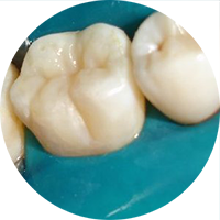 Изоляция зуба от слюны