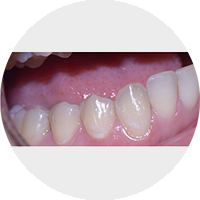 Покрытие поверхности поврежденного зуба восстанавливающим инфильтратом ICON